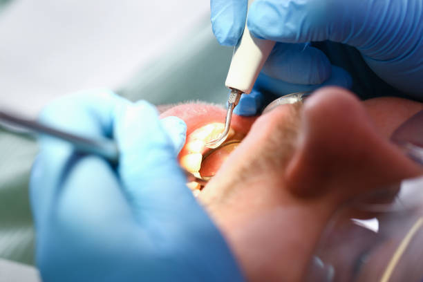 Best Dentist for Tooth Abscess  in Logan, OH