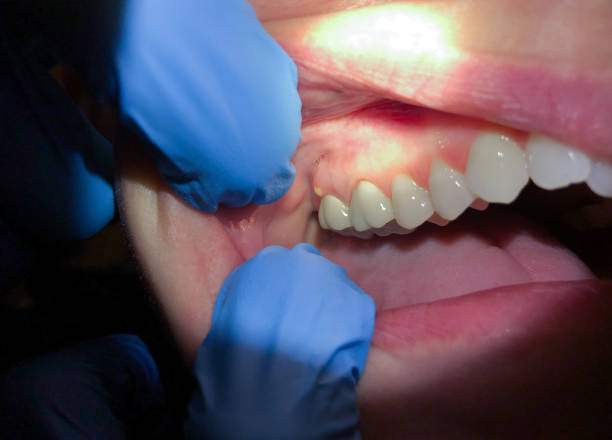 Best Chipped Tooth Repair Near Me  in Logan, OH